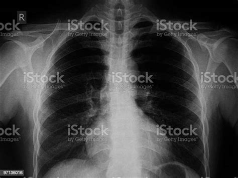 Chest Xray Image Stock Photo Download Image Now Chest Torso X