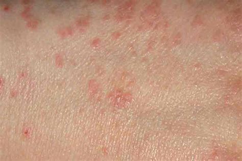Scabies Communicable Diseases Public And Environmental Health
