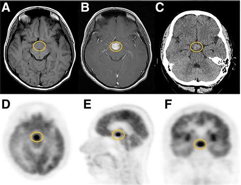 18f Fdg Petct For The Evaluation Of Primary Eosinophilic Granuloma Of