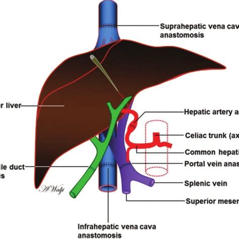 A Schematic Of A Pancreas Transplant Shows The Vascular And Visceral