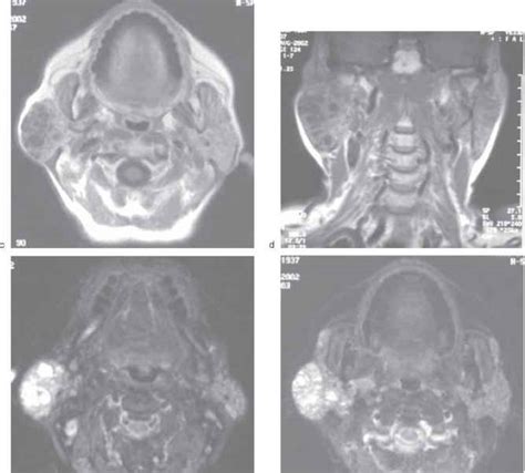 Hereditary And Congenital Conditions Salivary Gland Pathology