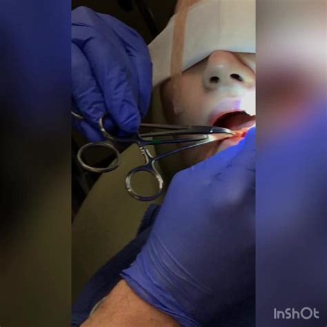 Buccal Fat Removal With Robb GRAPHIC Video RealSelf