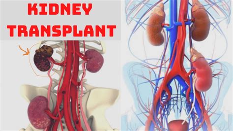 Kidney Transplant How Serious Is A Kidney Transplant Side Effects