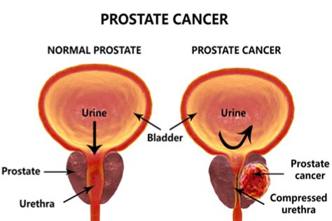 Early prostate cancer usually causes no symptoms or signs. Prostate Cancer : Facts,risk-factors, symptoms, diagnosis ...