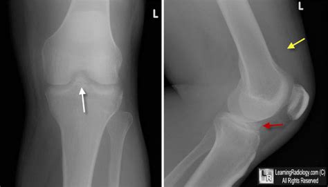 Learning Radiology Avulsion Fracture Anterior Tibial Spine