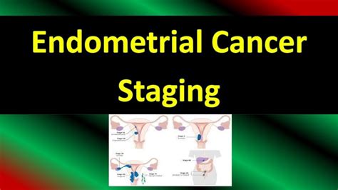 Endometrial Cancer Staging Figo Guideline Updates Youtube