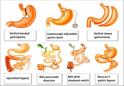 Types Of Weight Loss Surgery