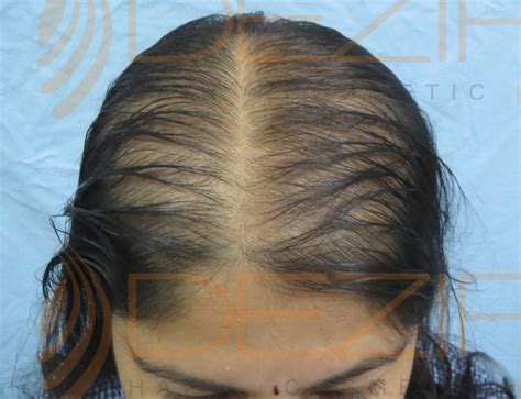 Female Pattern Hair Loss Done At Dezire Clinic Pune Hair Transplant Pune