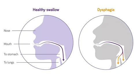 Enhancing The Quality Of Life Air With Flavour For Dysphagia