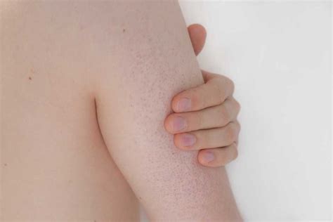What Is Keratosis Pilaris Heres Everything You Need To Know About Strawberry Legs Musely