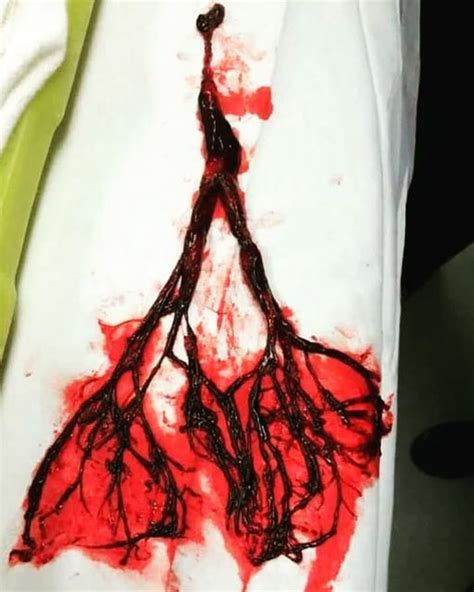 A Picture Of A Blood Clot Removed From An 80 Year Old Patient After He
