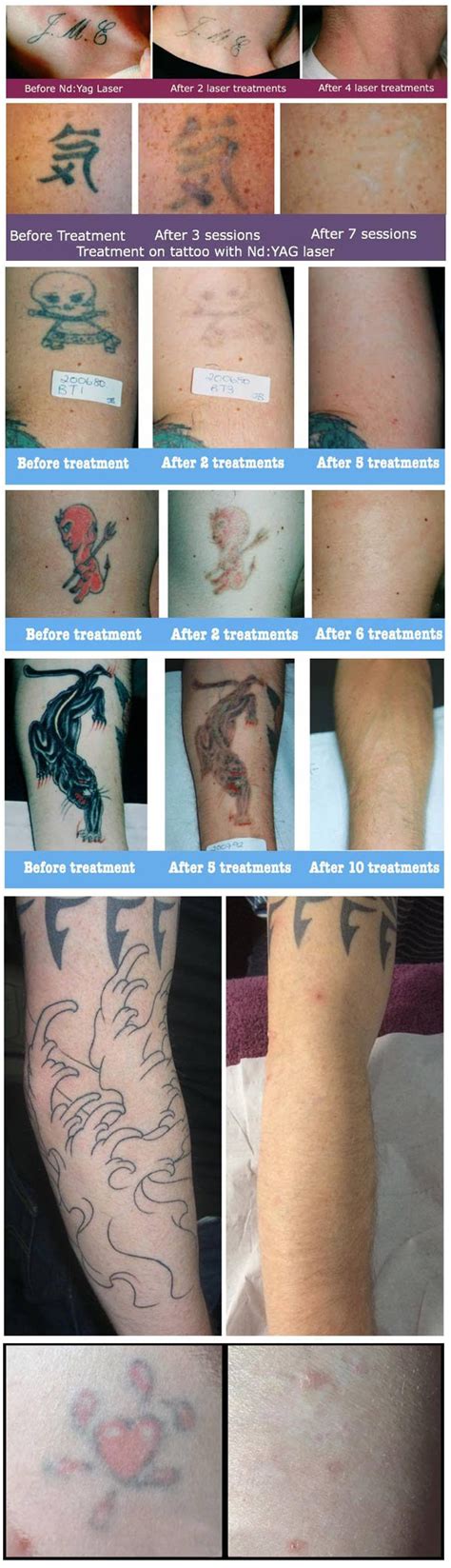 how many sessions needed to remove tattoo why it takes multiple sessions to remove a tattoo
