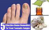 Bleach Toenail Fungus Home Remedies