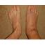 What You Need To Know About Ankle Edema / Swelling  Healthcare