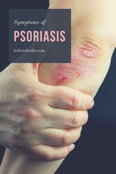Pin On Skin Disorders And Psoriasis
