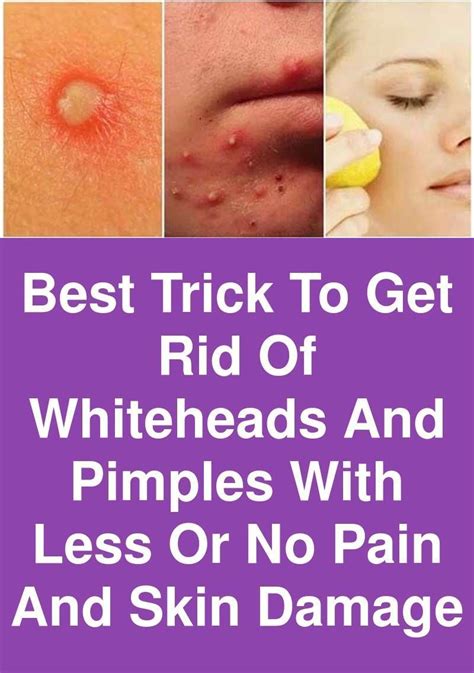 Take Care Of Your Skin With These Simple Steps Whiteheads Pimples