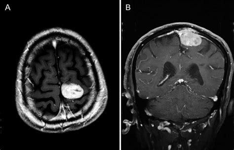 Patient 2 A Axial Post Gadolinium Contrast Enhanced Mri Of The Brain