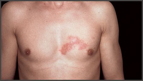Pictures Of Shingles On Chest Shingles Expert