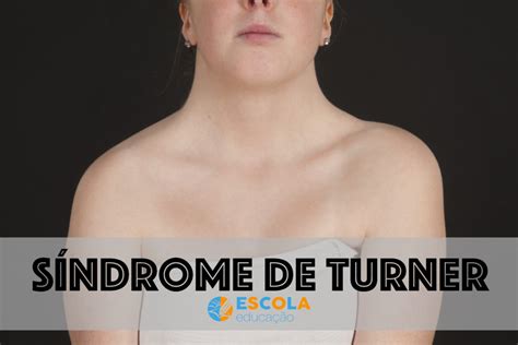 Síndrome de Turner O que é causas sintomas tratamento
