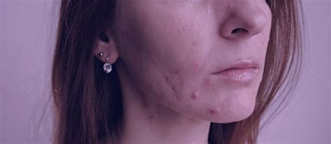 Is Tretinoin Good For Cystic Acne