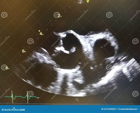 Aortic Valve Vegetation Shown On Live Echocardiogram Stock Image