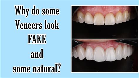 Fake vs. Natural looking Dental Veneers - YouTube