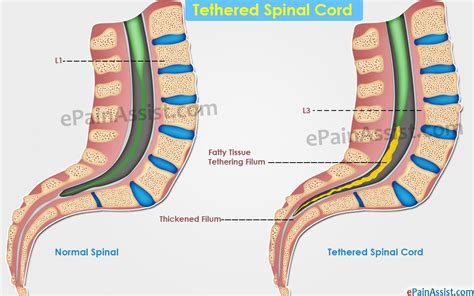 Tethered Spinal Cord Causes Symptoms Treatment Diagnosis
