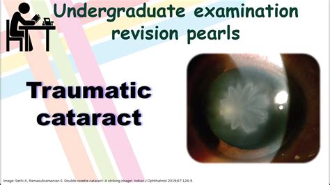 Traumatic Cataract Undergraduate Examination Revision Pearls 2 Youtube