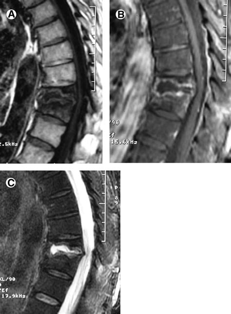Osteoporotic Compression Fracture At T10 And T11 Vertebrae In A