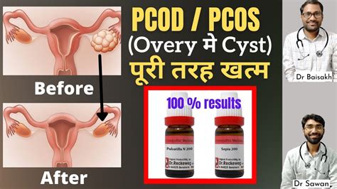 Best Homeopathic Medicine For Pcodpcos Overy Me Cyst Ka Homeopathic