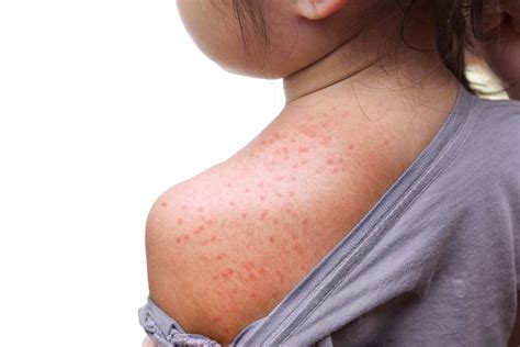 Petechiae In Babies Causes Symptoms And Treatment