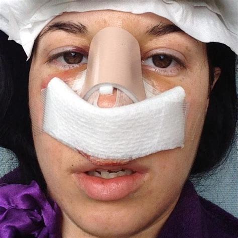 Correcting A Deviated Septum With Surgery Photos Rhinoplasty Cost