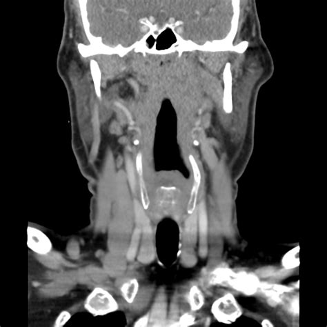 Palatine Tonsil Squamous Cell Carcinoma Image