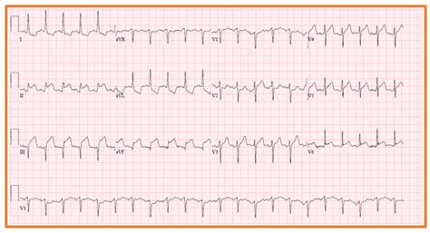 Figure 2 12 Lead Ecg Showing Sinus Tachycardia Q Waves With St