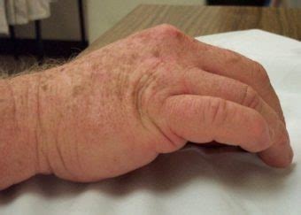 A boxer's fracture is the break of the 5th metacarpal bones of the hand near the knuckle. Boxer's fracture • LITFL • Trauma Library