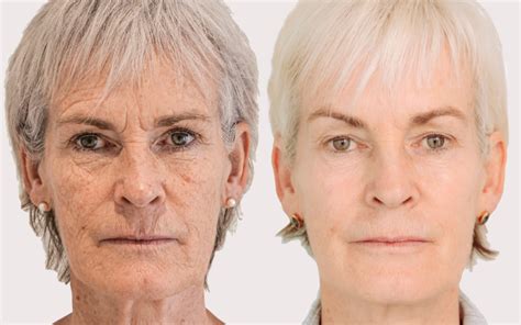 The £4500 Face Lift Judy Murray Had To Fix Her ‘turkey Neck