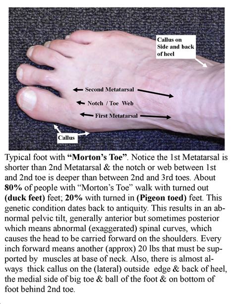 Nw Massage Guy Mortons Toe And Location For The Insert