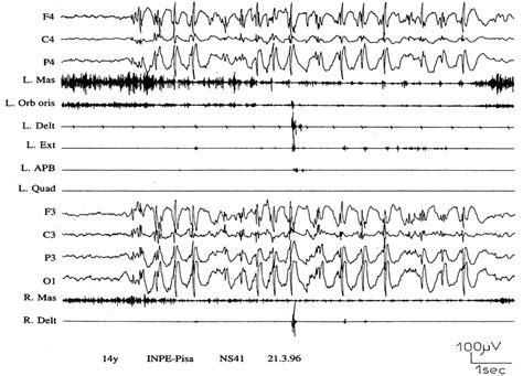 Epileptic Encephalopathies With Myoclonic Seizures In Infant
