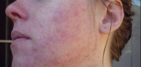 Pictures Of Irritated Skin Dorothee Padraig South West Skin Health Care
