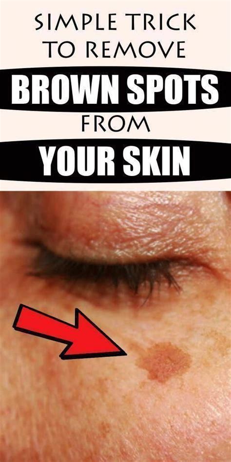 The Best Way To Get Rid Of Brown Spots On Face