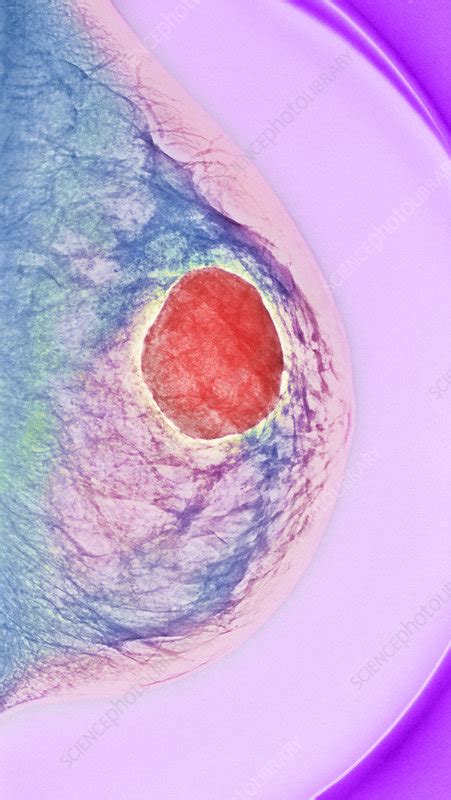 Breast Cyst X Ray Stock Image M1220295 Science Photo Library
