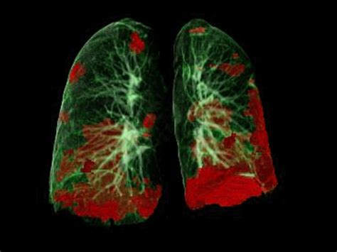 Lung Autopsies Of Covid Patients Reveal How Virus Spreads And
