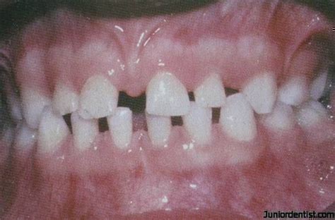 Developmental Disturbances In Teeth