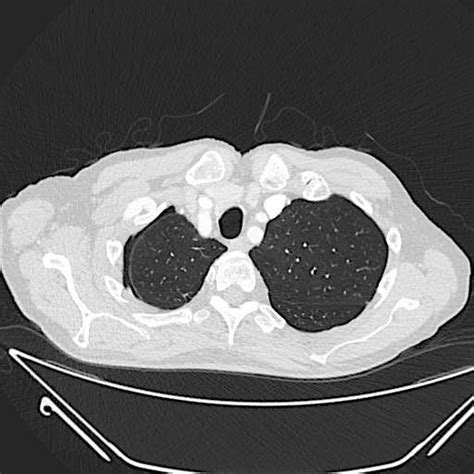 Ct Image Demonstrating The Small Right Apical Pneumothorax 3 Months