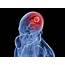 Brain Tumor Causes Symptoms Treatment
