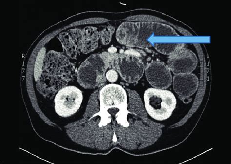 The Abdominal Computerized Tomography Showed Small Bowel Obstruction
