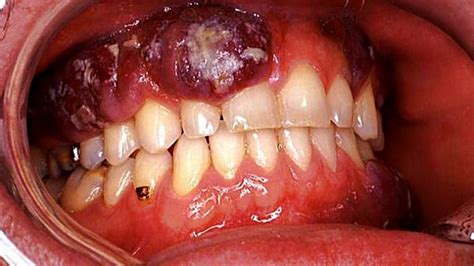 Mouth Cancer From Chewing Tobacco Signs Cancerwalls