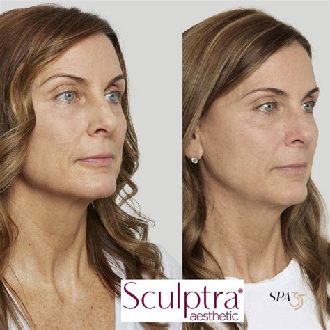 Dermal Fillers In Boise Idaho Sculptra Spa 35