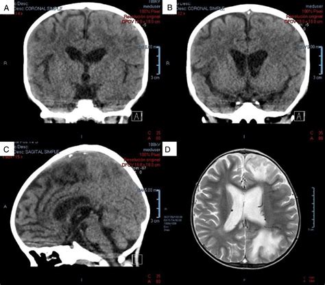 Trombosis Del Seno Venoso Sagital Superior En Paciente Pedi Trico Con