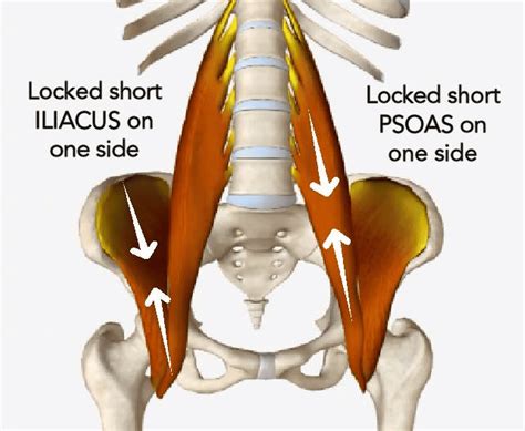Is There A Difference In Symptoms Between Iliopsoas Syndrome And Pelvic